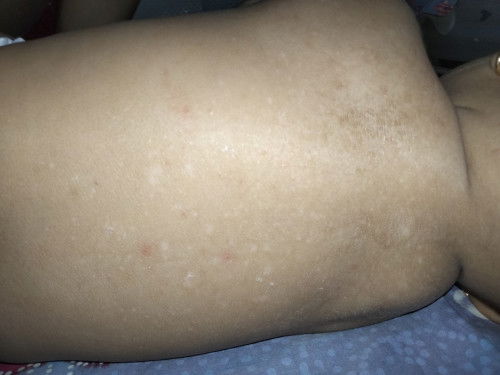 Bintik putih di punggung bayi