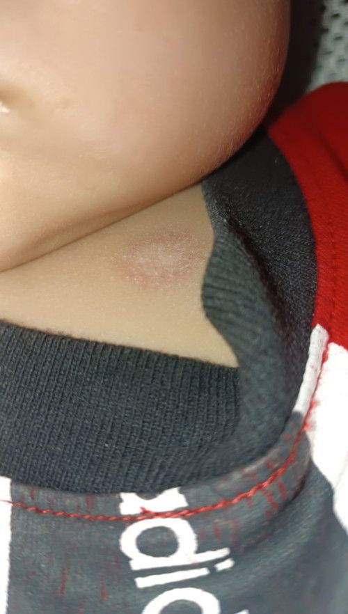 ลูกขึ้นผื่นวงสีแดง