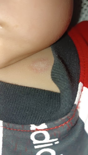 ลูกขึ้นผื่นวงสีแดง