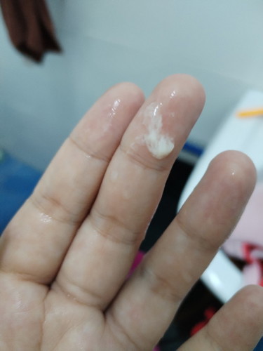 Keputihan atau lendir berwarna putih susu
