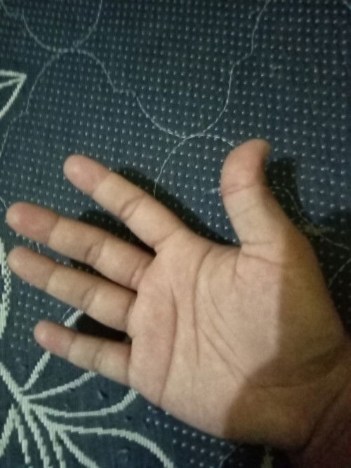 Tangan kebas/kesemutan