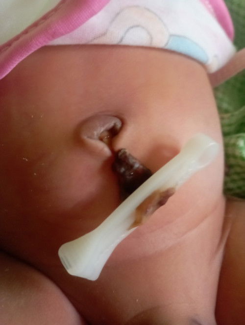 Tali pusar bayi kering tp belum lepas