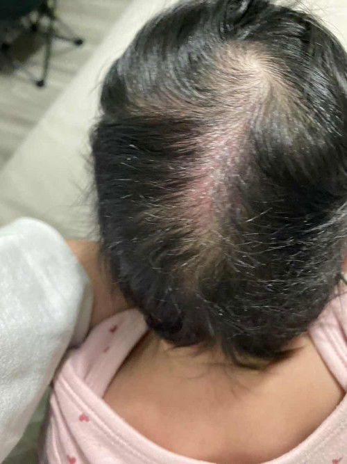 ลูก2เดือน22วัน หนังศีรษะเป็นแบบนี้ทำไงดี