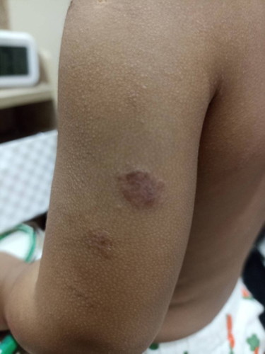 ลูกมีผื่นขึ้น เกาๆจนเป็นดวงๆ แบบนี้คะ 1-2 วันนี้ตื่นมาร้องตลอด มีครีมแบบไหนช่วยรักษาบ้างไหมคะ