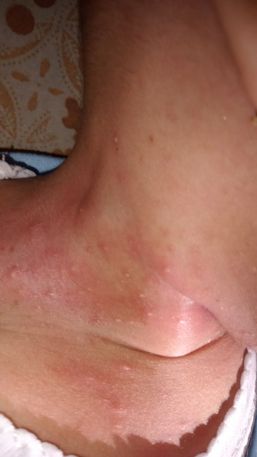 Bintik bintik merah pada bayi 9 bulan di leher