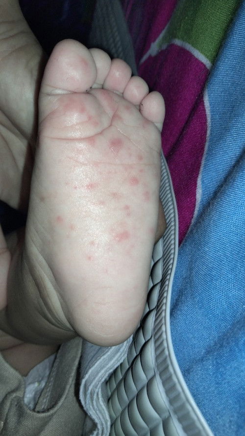 Bintik merah di telapak kaki bayi