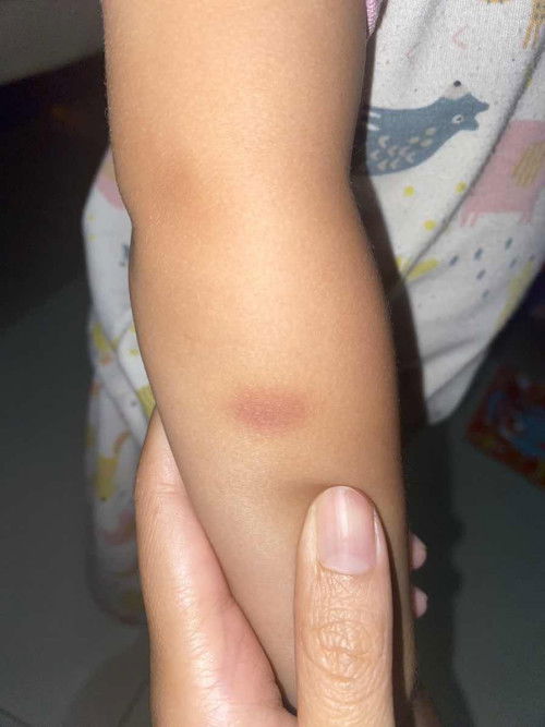 Lebam ungu tiba2 pada anak