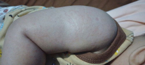 ruamm karna keringat atau alergi