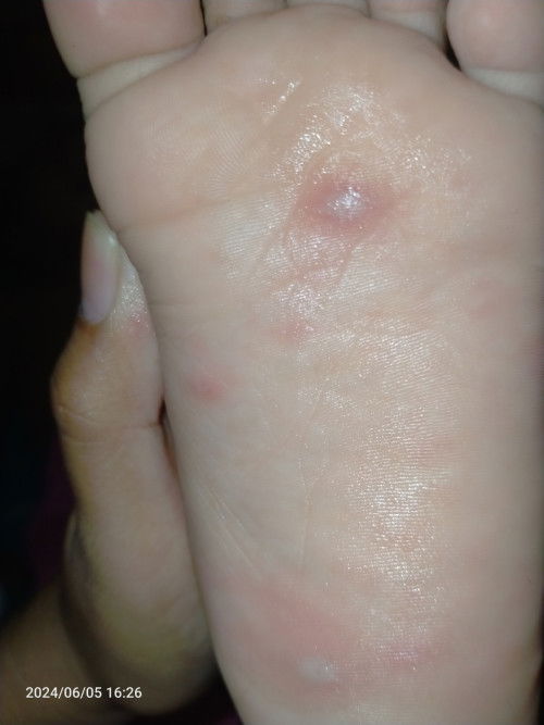 Bentolan kecil isi air di kaki anak