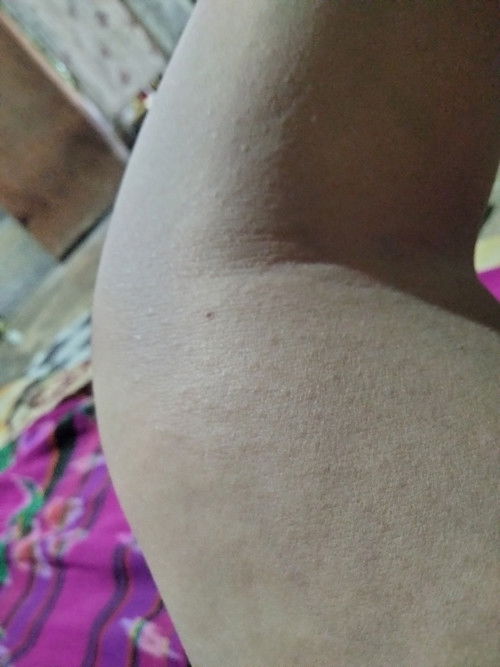 Sakit kaki, bengkak tangan