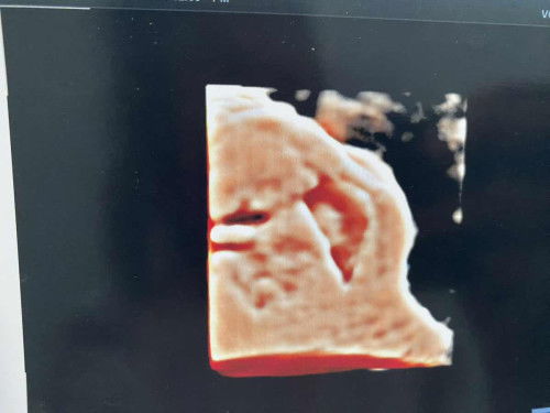 Usg 9minggu 1hari ada janin dan djj nya