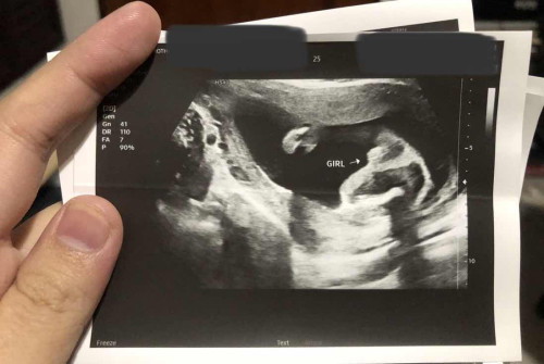Gender Boy or Girl