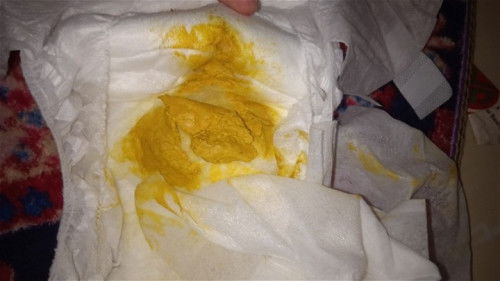 Peses bayi menggumpal