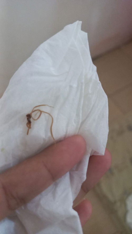 Jahitan pasca lahiran normal lepas. Apa berbahaya