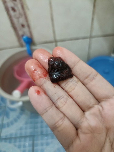 5 weeks pregnant base sa TVU, may lumabas na parang laman nasa kutsarita ang sukat po.