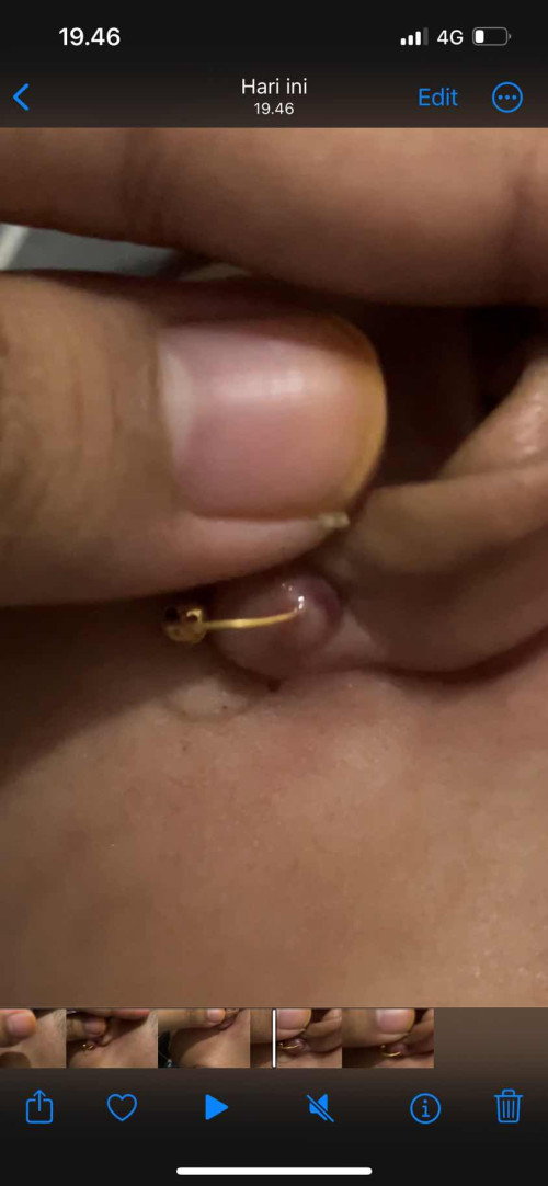 Telinga Bengkak
