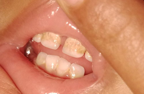 Masalah gigi anak 1 thun 4 bln