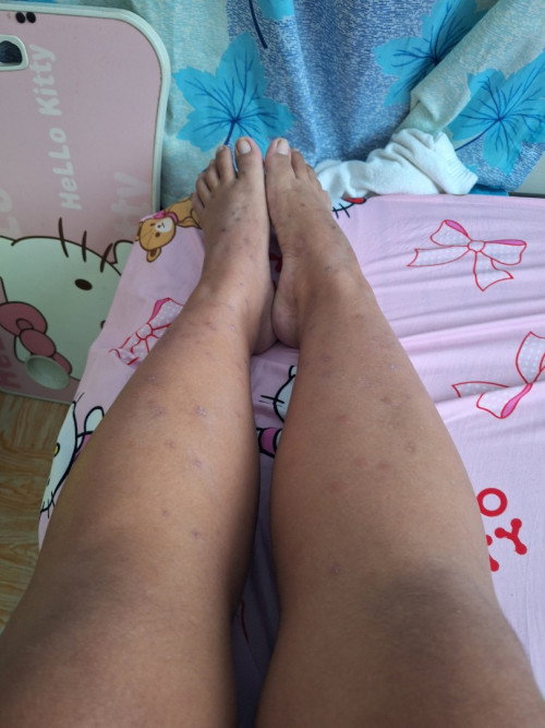 legs rashes like insect bites 5 months pregnant