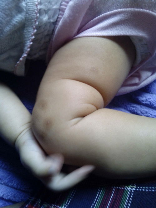 Dari usia 4 bulan kemarin banyak bentol