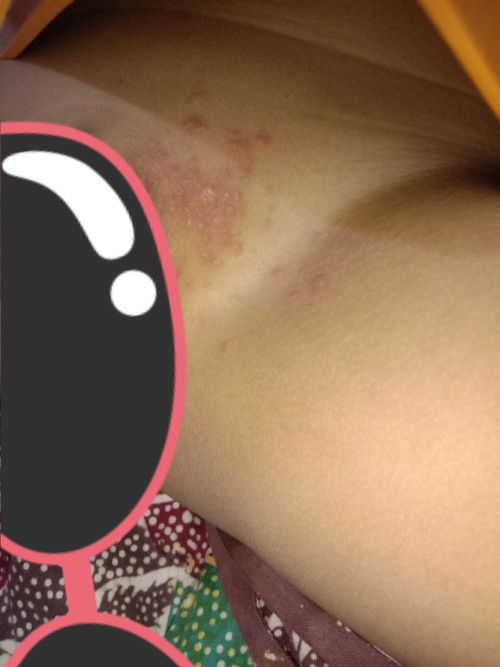 miconazole untuk anak