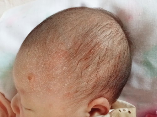 แม่ๆท่านไหนมีประสบการณ์ลูกเป็นตุ่มเล็กใสๆ แบบนี้บ้างค่ะ
