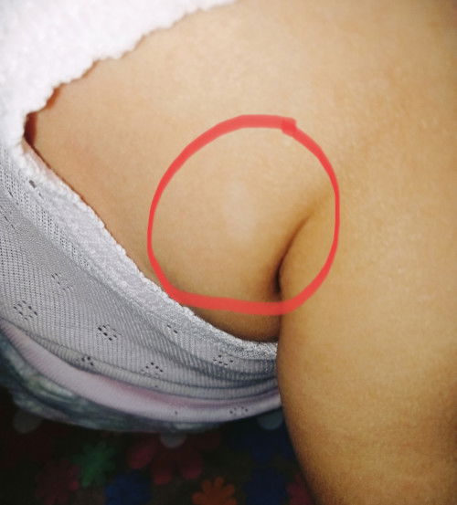 Bercak putih di pundak