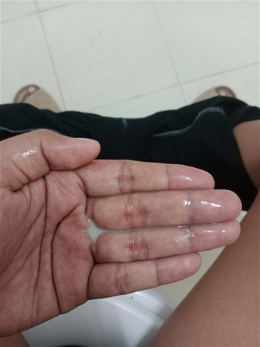 มีน้ำสีขาวขุ่นไหลออกจากช่องคลอด