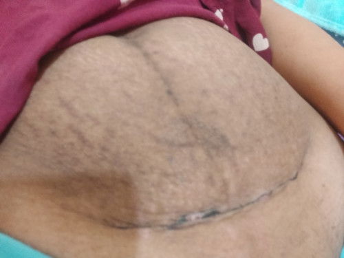 Rawat bekas jahitan sc