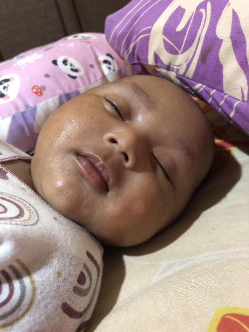Ruam dipipi bayi