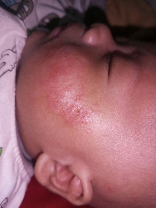 pipi bayi merah dan berair