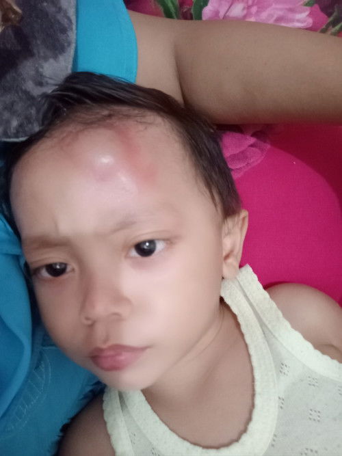 Benjol di jidat karena jatuh