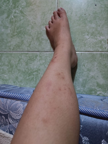 12 weeks preggy Normal lang ba ito First time pregnancy ko po ito.
Sobrang kati ng mga katawan ko