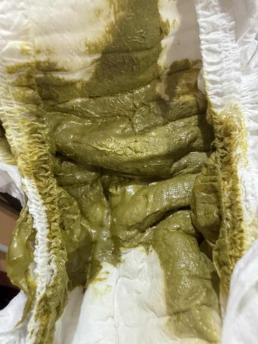 stool @ berak bayi 2bulan 20hari tukar dari mistard ke hijau