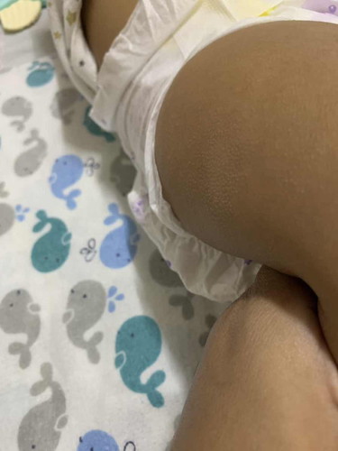 Ruam kulit baby