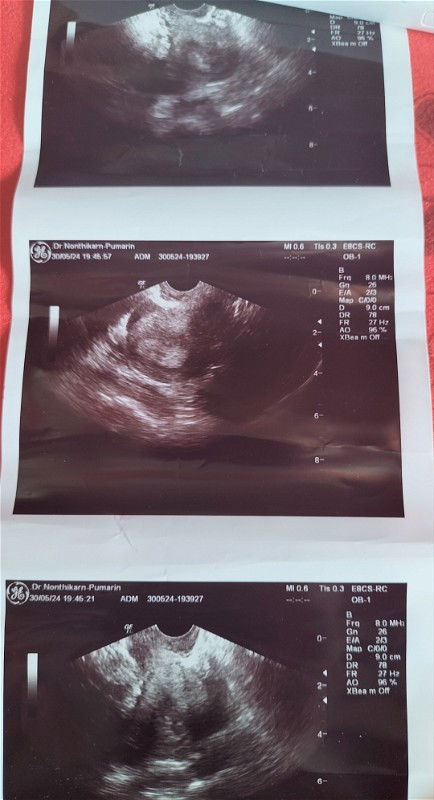 พค3.5พอ19พคตรวจ2ขีดจางๆกี่อันก็เหมือนกัน30พคไปอันตร้าซาวเจอถุงตั้งครรภ์3wพอมาวันนี้มีเลือดเหมือน ปจด
