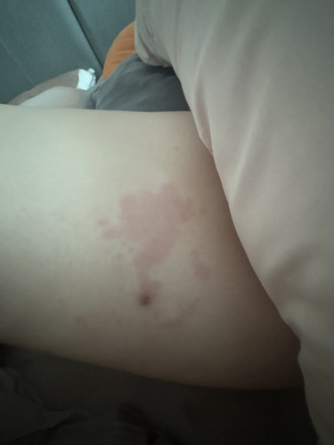 Rashes on leg