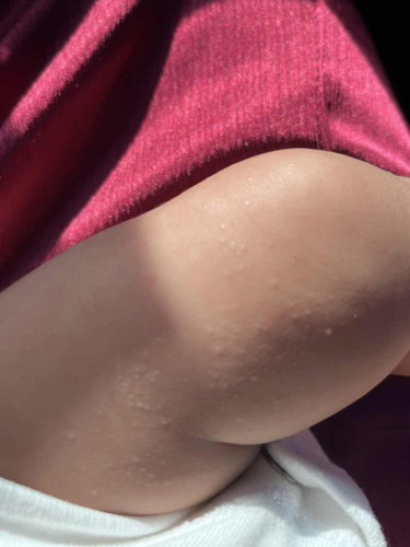 Ruam panas atau allergic