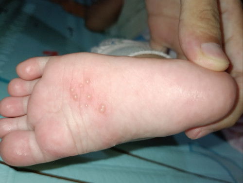 Muncul bintik-bintik di kaki baby 5 bulan