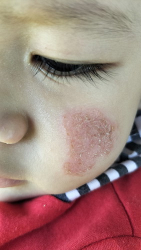 Ruam merah pipi bayi