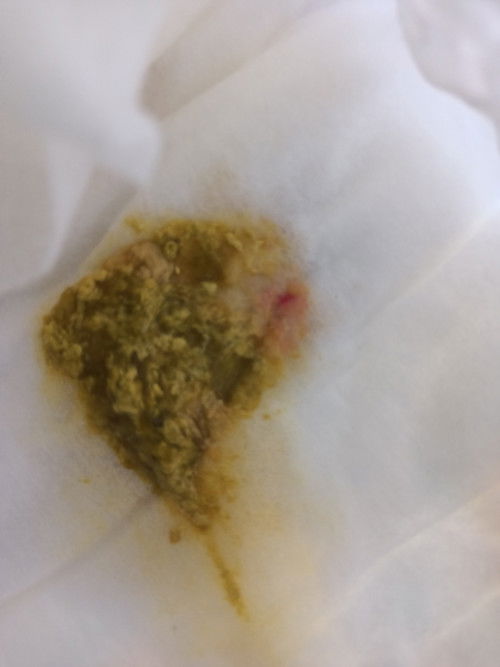 อุจระปนเลือด