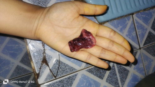 Hamil ektopik keluar Gumpalan daging