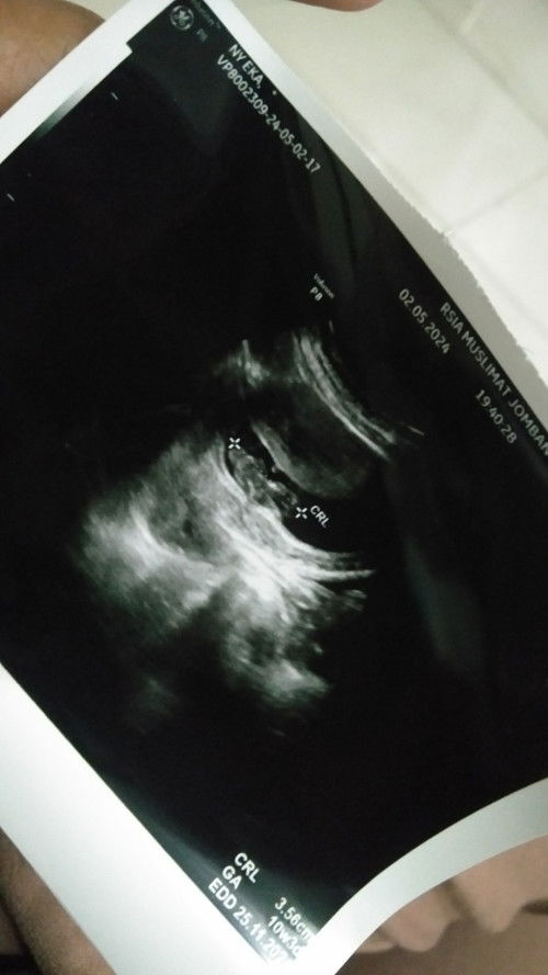 Hamil 16week jarang kerasa pergerakan baby apakah wajar bun?