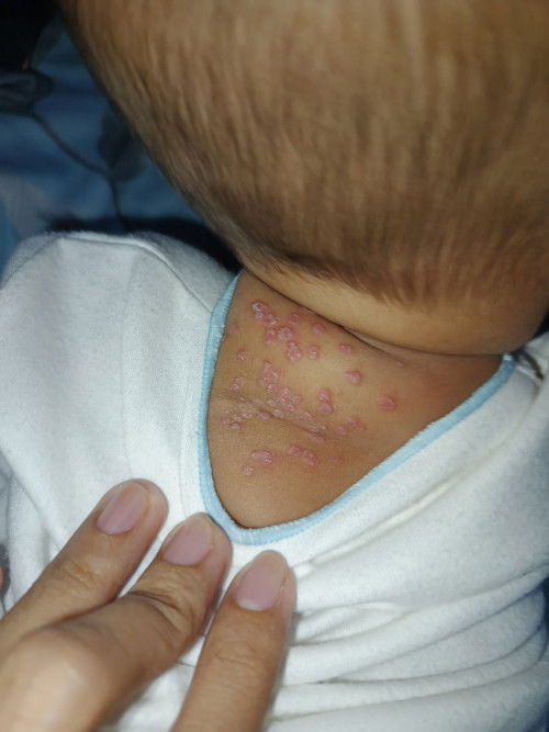 Bintik Bintik merah di punggung