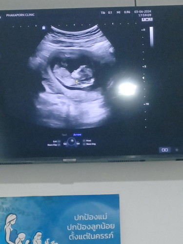 12w แม่ๆคิดว่าน้องเพศอะไรคะ