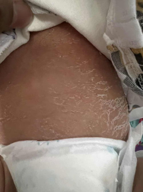 4/6 bersalin . Nak tanya kulit yg mcmni dkt baby , berapa hari bole tanggal ye ??