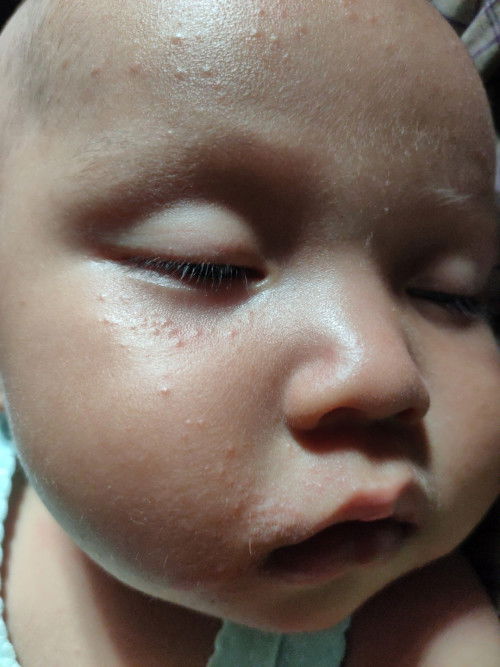 Ruam di wajah bayi