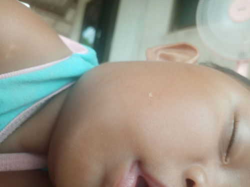 คางบวมเหมือนมีก้อนอะไรอยู่ในคางลูกเเม่ๆบ้านไหนเคยเป็นมั้ยคะเเนะนะหน่อย