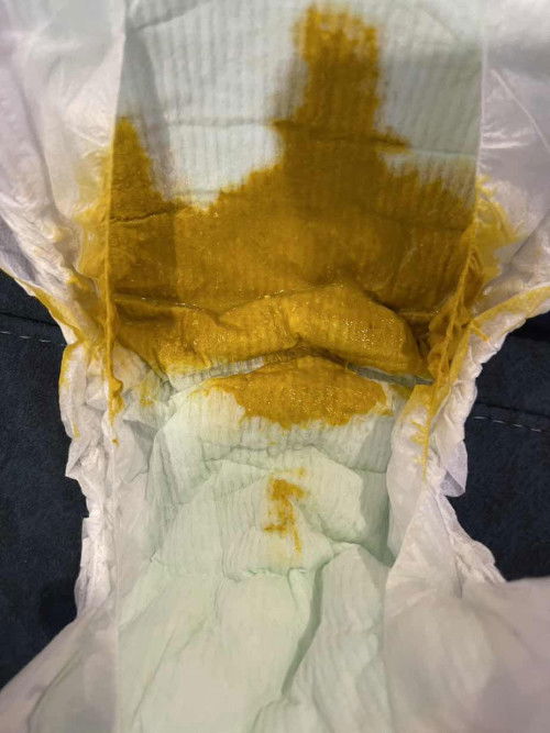 ขี้แบบนี้ปกติไหมคะ