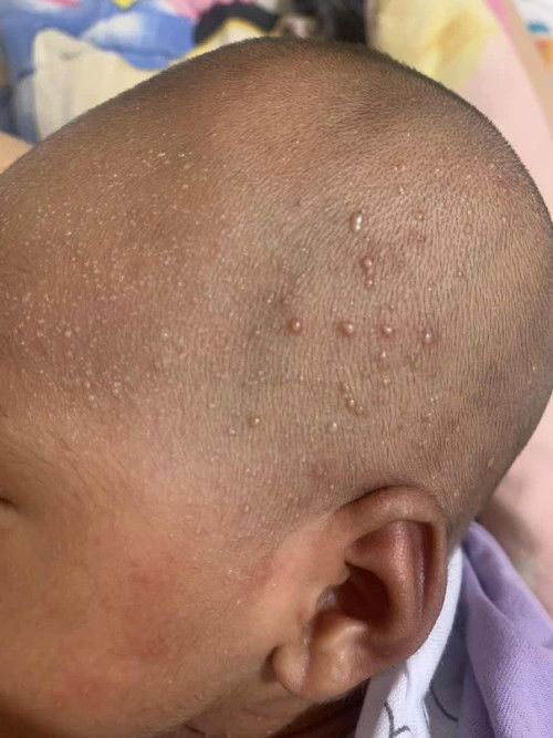 Bruntusa spt ada nanah nya