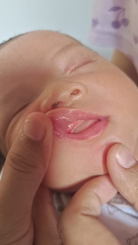 Bruntusan putih kecil pada gusi bayi 3minggu